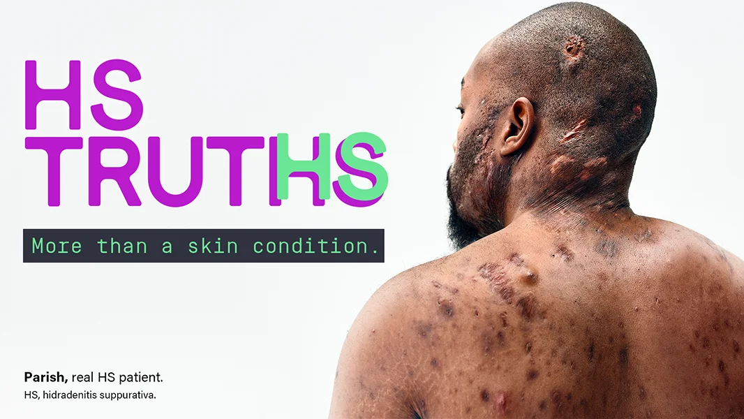 To the right of the image, a Black man, with hidradenitis suppurativa (HS), poses facing away from the camera with his back exposed, showing scars from his HS flares. To his left reads a headline "HS TRUTHS more than a skin condition." Below the headline is a tag with the patients name which reads "Parish, real HS patient." The footnote reads "HS, hidradenitis suppurativa."