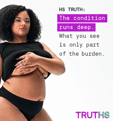 To the left of the image, a Black woman poses looking into the camera while lifting up her shirt, showing scars from her hidradenitis suppurativa (HS) flares under her right and left breast. To her right reads a headline "HS TRUTHS: The disease runs deep. What you see is only part of the burden." Below the headline is a tag with the patients name which reads "Jasmine, real HS patient. To the right is the TRUTHS logo with the HS in TRUTHS highlighted in teal. 