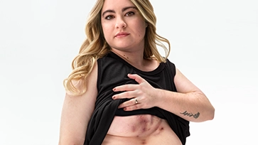 A White woman with blonde hair poses looking into the camera lifting up her shirt, showing scars from her hidradenitis suppurativa (HS) flares under her right breast.