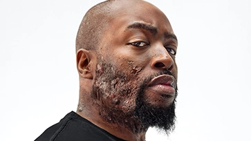 A Black man, with hidradenitis suppurativa (HS), poses with a look of defiance into the camera.