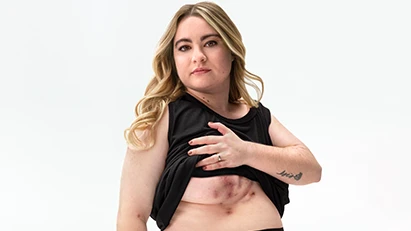 A White woman who has blonde hair poses looking into the camera lifting up her shirt, showing scars from her hidradenitis suppurativa (HS) flares under her right breast.