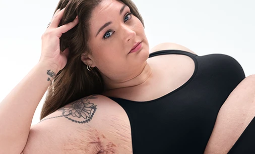 A White woman with brown hair poses looking into the camera while laying down, with her head being supported by her right hand showing scars from her hidradenitis suppurativa (HS) flares under her right armpit. 