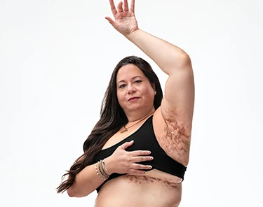 To the right of the image, a woman with brown hair poses looking into the camera while raising her left hand showing scars from her hidradenitis suppurativa (HS) flares in her armpit. To her left reads a headline: "HS TRUTHS: Progress has been made, but gaps in HS care remain." Below the headline is a tag with the patient's name which reads "Tatiana, real HS patient." 