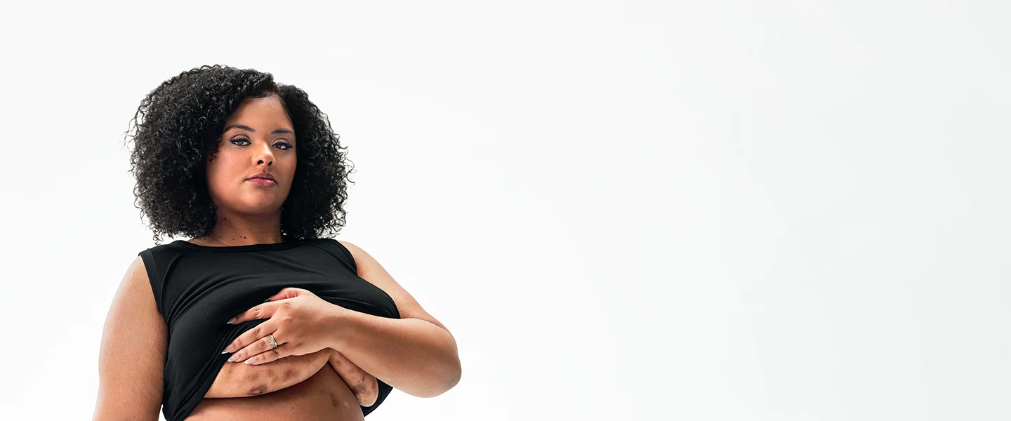 To the left of the image, a Black woman poses looking into the camera while lifting up her shirt, showing scars from her hidradenitis suppurativa (HS) flares under her right and left breasts. To her right reads a headline: "HS TRUTH: HS runs deep. What you see is only part of the burden." Below the headline is a tag with the patient's name which reads "Jasmine S, real HS patient."