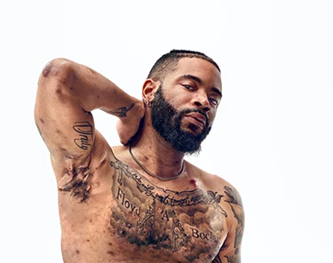 To the right of the image, a Black man with a beard, and hidradenitis suppurativa (HS), poses facing the camera with his tattooed chest exposed, with his arm up to show scars from his HS flares. To his left reads a headline: "HS TRUTH: HS Education & Resources | Learn more about the science behind HS and how patients with HS navigate their lives". Below the photo is a tag with the patient's name which reads "Jawan, real HS patient." 