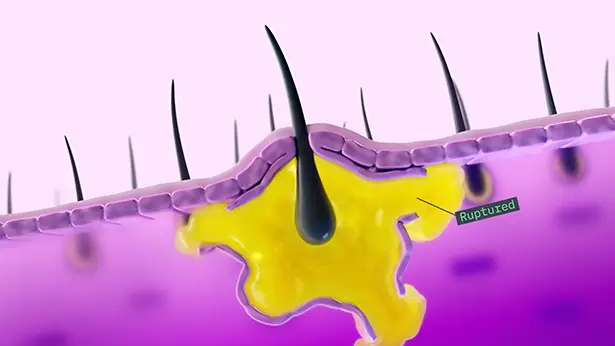 Illustration showing a blocked and swollen hair follicle under the skin, depicting how it becomes occluded and then ruptures, releasing debris into the dermis
