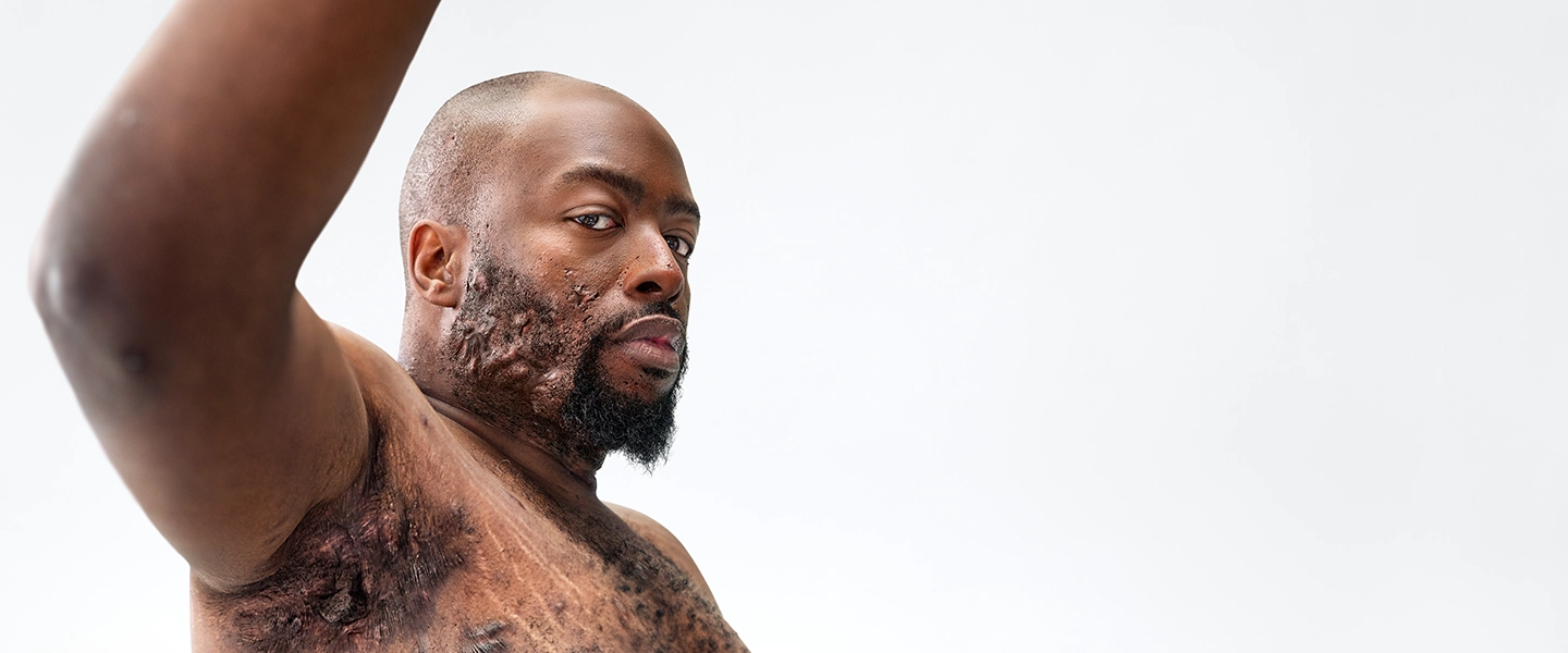 To the left of the image, a Black man with a beard, and hidradenitis suppurativa (HS), poses facing the camera with his tattooed chest exposed, showing scars from his HS flares. To his left reads a headline: "HS TRUTH: Patients are ready for more. Let's raise the bar in HS care". Below the headline is a tag with the patient's name which reads "Jawan, real HS patient." 