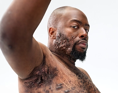 To the left of the image, a Black man with a beard, and hidradenitis suppurativa (HS), poses facing the camera with his tattooed chest exposed, showing scars from his HS flares. To his left reads a headline: "HS TRUTH: Patients are ready for more. Let's raise the bar in HS care". Below the headline is a tag with the patient's name which reads "Jawan, real HS patient." 