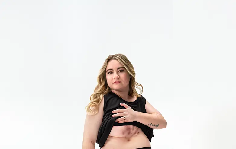 A White woman who has blonde hair poses looking into the camera lifting up her shirt, showing scars from her hidradenitis suppurativa (HS) flares under her right breast.